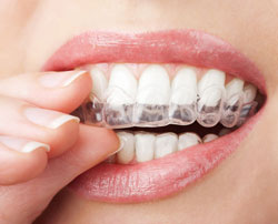 hand putting clear teeth aligners into mouth, Livonia, MI Invisalign
